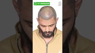 Best Hair Transplant Results | Latest Fue Technique #shorts #viral #hair transplant