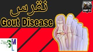 Gout Disease / نقرس