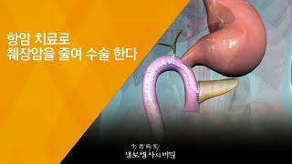 함암 치료로 췌장암을 줄여 수술 한다 - (2018.4.4_642회 방송) 취장암, 희망은 있다