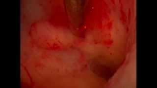 Hysteroscopy for Uterine Polyp Removal