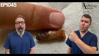 Ear Wax Extraction A MAMMOTH Ear Wax Removal - EP1045