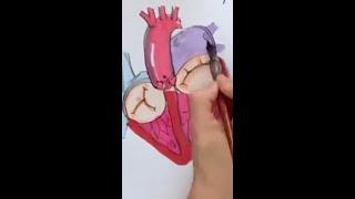 Mitral Regurgitation and KISS Repair: A Doodle Journey