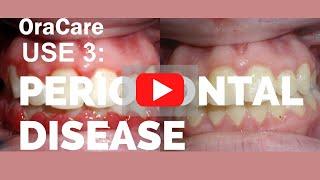 OraCare Use 3: Periodontal Disease