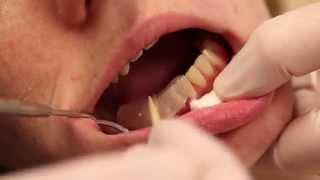 Composite Addition Dentistry Procedure