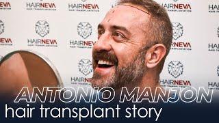 Antonio Manjon's Hair Transplant Story | Hair Neva Premium Hair Transplantation