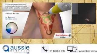 Q-Switched Laser Tattoo Removal, Quanta  Q Plus C