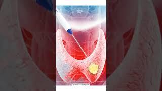 Thyroid Nodule Treatment without surgery | Dr. Gaurav Gangwani