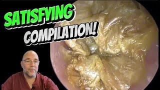 SATISFYING COMPILATION! 319 #ear #earwax #earwaxremoval #fyp #satisfying #foryou #fyp #foryourpage