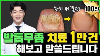 발톱무좀 치료 1만번 해본 피부과전문의가 말합니다 (발톱무좀약, 발톱무좀레이저, 발톱무좀제거)