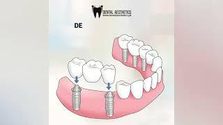 Dental Implants Are The Best Options For Missing Teeth | Dentist in Lahore | Dental Aesthetics