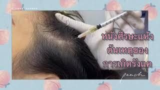 Hair regrow at Degree clinic