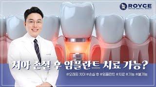 로이스치과 밀양점 원장님이 알려주는 임플란트 상식 Part.2