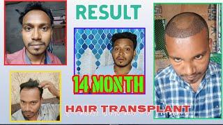 True Lines OF ️ HAIR TRANSPLANT /Result Of 14 Month + #KOLKATA