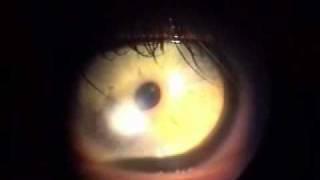 Esclerocornea