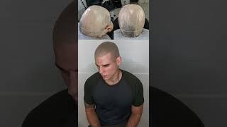 Scalp Micropigmentation For Alopecia  #scalpmicropigmentation #alopecia #hairtattoo #hairloss