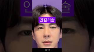 시술로 안검하수 눈매교정의 효과를!? #안검시술 #시술후기 #리얼모델