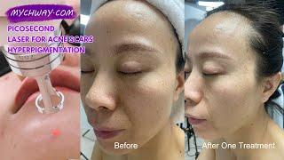 Picosecond Laser for Acne Scars & Hyperpigmentation: Before & After | Erasing Your Acne Scars | AS60