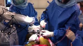 Total Hip Replacement Using MAKO Robotic Assistance