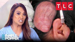 Life-Changing Pops | Dr. Pimple Popper | TLC