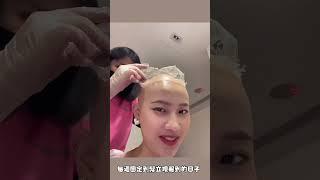 部落客 現身說法#生髮歷程#【你的落髮有救了】#圓型禿#自然生髮#髮立現診所