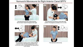 Vannucchi Manoeuvre for Right Anterior Canal BPPV