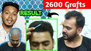 Only 2600 Grafts On Grade 3 Boldness !! Hair Transplant