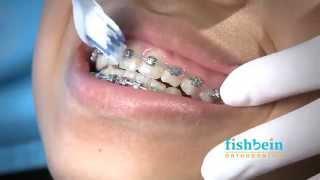 Orthodontic Home Care Instructions | Braces | Brushing