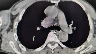 CT GE brief parameters for Pulmonary Angio, PE study,