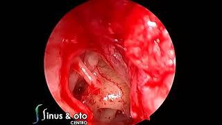 Endoscopic Stapedotomy - Officulum Quartum