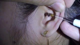 Girl's Nasty Black Earwax Removal