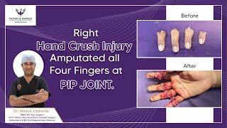 Emergency Hand Surgery: Replantation of Four Traumatic Amputated Fingers