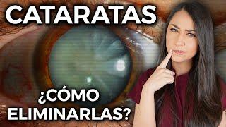 This is how you get rid of CATARACTS  l Everything you need to know ‍️ @DraPauZuniga