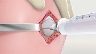 MACI Surgical Animation: Surgical Technique