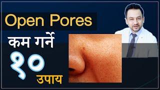 OPEN PORES को उपचार । घरेलु उपचार । Home treatment