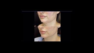 Lipo - Stubborn Under Chin Fat treatment - Ageless MD