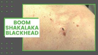 Boomshakalaka Blackhead | Dr. Derm