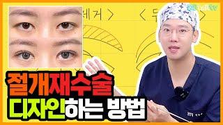 절개재수술 디자인하는 방법