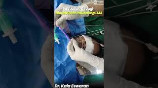 Intubating through Blockbuster Intubating LMA