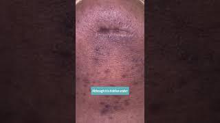 COMPLICATED SCAR REVISION - DR. TANVEER JANJUA- NEW JERSEY