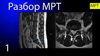 МРТ-разбор: грыжа (экструзия) межпозвонкового диска L5-S1