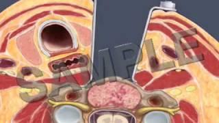 Anterior Cervical Fusion: 3D/2D Medical Animation