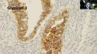 Tip-90;Ovarian Yolk Sac Tumor in a Postmenopausal Patient