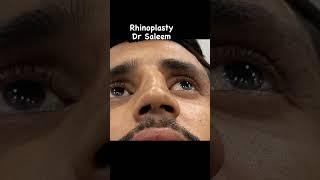 Rhinoplasty surgery in Pakistan, lahore by doctor Saleem. #rhinoplastybeforeandafter #rhinoplasty