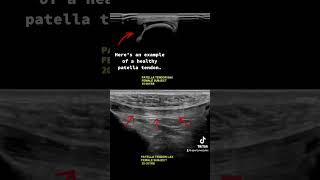 #ultrasound Guided Interventions: Healthy Images (Patella Tendon)