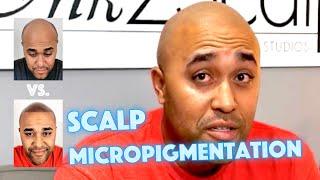 See Andre's Scalp Micropigmentation Transformation with Ink 2 Scalp Studios in Ontario