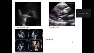 Echo Conference 11/12/2024  (COP measurement by TTE)