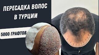 Пересадка волос в Турции | Пересадка Волос процесс 5000 графтов #пересадкаволос