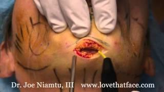 Niamtu Cosmetic Surgery Education Volume 2 Trailer