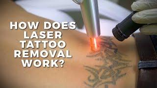 How Does Laser Tattoo Removal Work? | Claudio Explains | Body Details