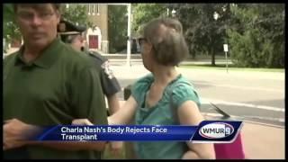 Charla Nash’s body rejects tissue from face transplant